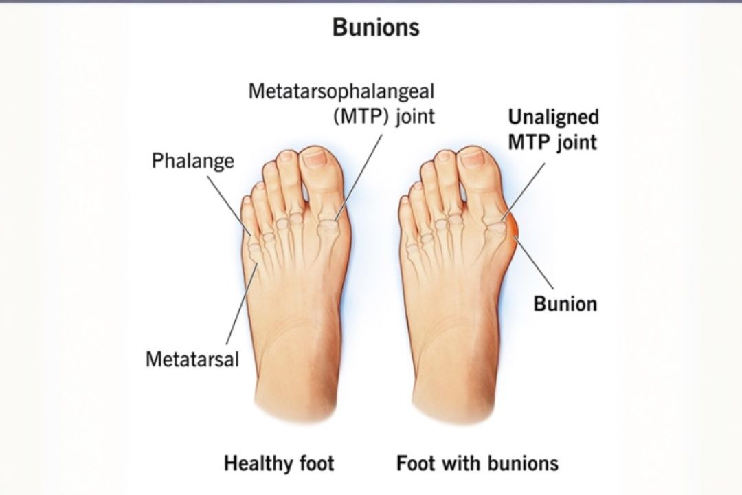 Bunions