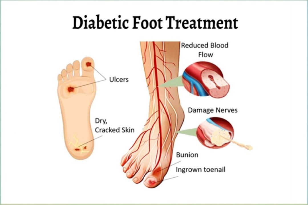 Diabetic