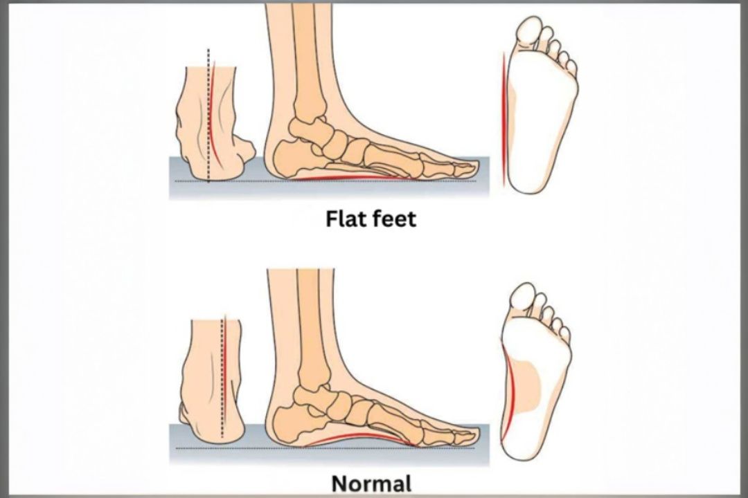 Flat Feet