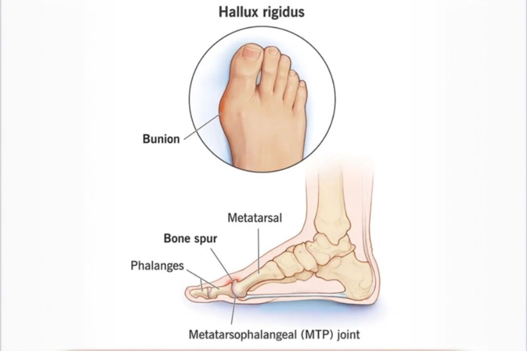 Hallux Rigidus