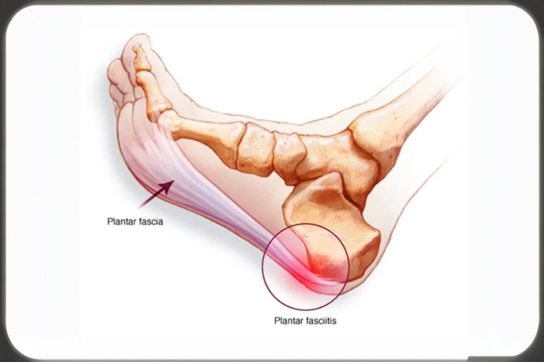Heel Pain