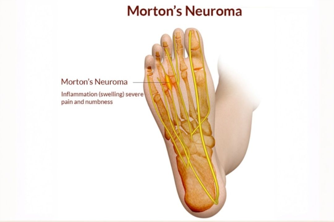 Mortons Neuroma