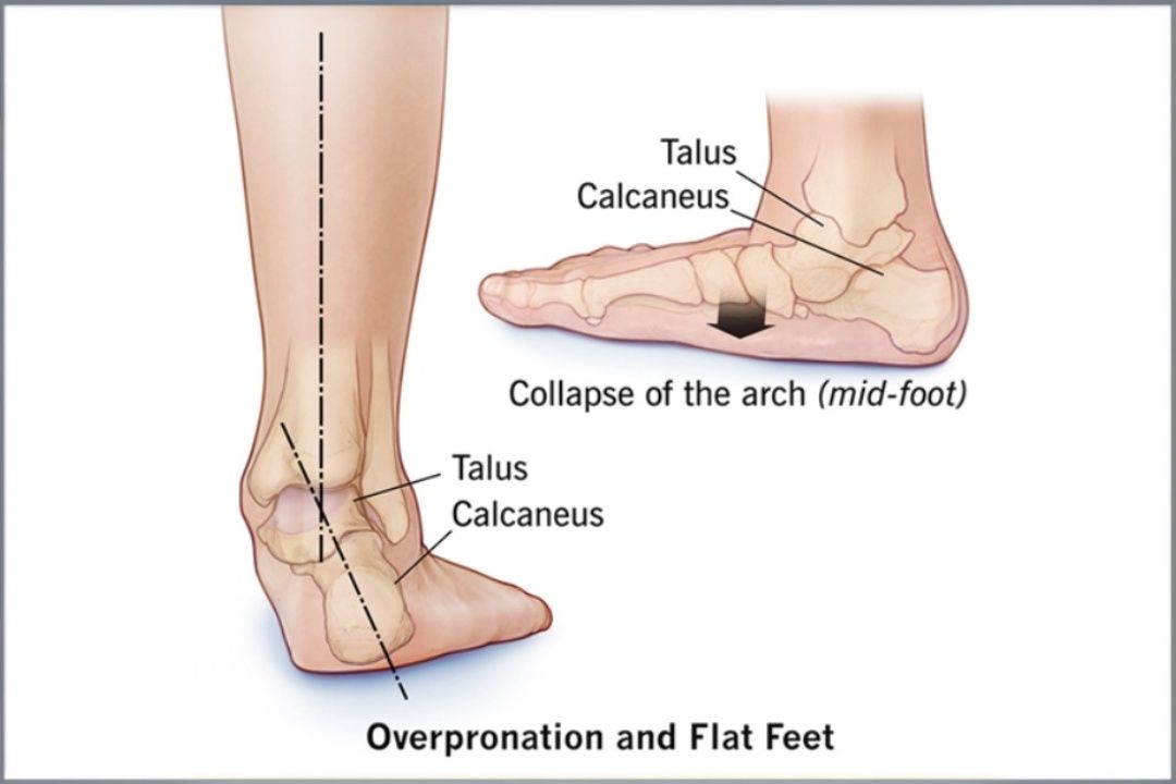 Overpronation