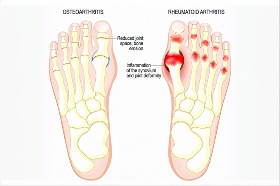 Toe Pain