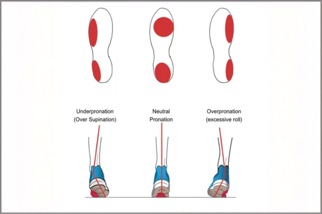 Underpronation